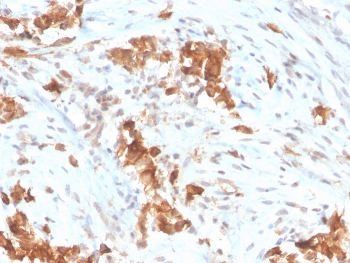 Mesothelin Antibody Mesothelioma IHC. Immunohistochemistry analysis of mesothelin expression in FFPE human mesothelioma using clone MSLN/3385. Tumor cells demonstrate membranous HRP-DAB brown staining with focal cytoplasmic signal, consistent with mesothelin surface localization. The staining pattern highlights mesothelial tumor cell populations while maintaining low background in surrounding stromal elements. The clear and selective signal is consistent with microarray specificity validated performance, supporting high-confidence detection of mesothelin in tissue sections. Heat-induced epitope retrieval was performed using pH 9 Tris-EDTA buffer.