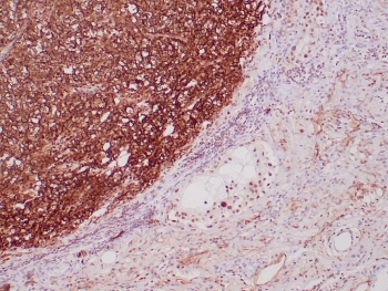 IHC staining of FFPE human seminoma tissue with recombinant Podoplanin antibody (clone PDPN/4009R). HIER: boil tissue sections in pH 9 10mM Tris with 1mM EDTA for 20 min and allow to cool before testing.