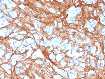 Immunohistochemistry of Periostin antibody for IHC in human colon carcinoma. Formalin-fixed, paraffin-embedded human colon carcinoma tissue was stained with mouse monoclonal Periostin antibody (clone POSTN/3501) following heat-induced epitope retrieval by boiling in pH 9 10 mM Tris with 1 mM EDTA for 20 minutes and cooling prior to testing. HRP-DAB brown chromogenic signal highlights abundant stromal and extracellular matrix regions surrounding malignant glands, consistent with the secreted and matrix-associated localization of Periostin, while tumor cell nuclei remain largely negative.