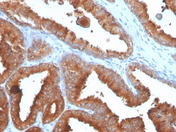 Recombinant Prostate Specific Antigen Antibody (clone rKLK3/4753) immunohistochemistry analysis of human prostate carcinoma. Formalin-fixed paraffin-embedded human prostate carcinoma tissue stained with Recombinant Prostate Specific Antigen Antibody clone rKLK3/4753 shows HRP-DAB brown chromogenic staining in malignant glandular epithelial cells. Strong cytoplasmic staining highlights tumor cells forming irregular glandular structures, with luminal accentuation consistent with secretion of Prostate specific antigen (KLK3). Surrounding stromal tissue remains largely negative. Heat induced epitope retrieval was performed by boiling tissue sections in pH 9 10mM Tris with 1mM EDTA for 20 minutes followed by cooling prior to antibody incubation.