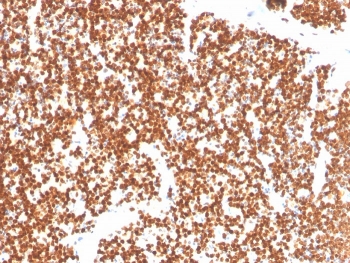 SF-1 Antibody Thymus IHC. Immunohistochemistry analysis of FFPE human thymus tissue stained with SF-1 Antibody demonstrates strong diffuse nuclear HRP-DAB brown staining throughout densely packed thymic cellular populations, consistent with expression of steroidogenic factor 1 / NR5A1 in endocrine-associated transcriptionally active cells. This steroidogenic transcription factor antibody highlights nuclear localization patterns associated with steroid hormone-responsive transcriptional regulation and endocrine lineage-associated signaling pathways. HIER: boil tissue sections in pH 9 10mM Tris with 1mM EDTA for 20 min and allow to cool before testing.