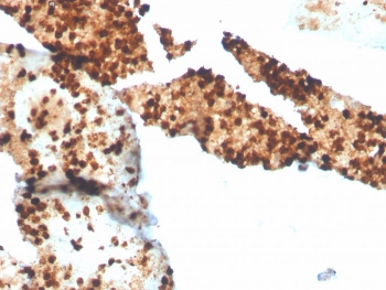 S100P Antibody Recombinant Rabbit MAb S100P/4386R in human spleen tissue. Immunohistochemistry staining of FFPE human spleen demonstrates cytoplasmic staining in scattered inflammatory cells consistent with expression of S100 calcium binding protein P / S100P, also known as migration inducing gene 9 (MIG9). Brown chromogenic signal highlights S100P-positive inflammatory cells within splenic tissue while surrounding lymphoid populations show comparatively weaker staining. Heat-induced epitope retrieval was performed by boiling tissue sections in pH 9 Tris buffer with 1 mM EDTA for 20 min before staining.