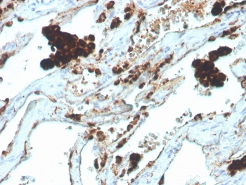 NAPSA Antibody for IHC. Immunohistochemistry analysis of Napsin A (NAPSA) expression in FFPE human lung adenocarcinoma demonstrates strong granular cytoplasmic HRP-DAB brown staining in tumor epithelial cells with minimal background in surrounding stromal regions. Clone NAPSA/4400R highlights Napsin A expression consistent with its role in proteolytic maturation and epithelial protein processing, supporting its use as a protein processing marker in pulmonary tissues. HIER was performed by boiling tissue sections in pH 9 10mM Tris with 1mM EDTA for 20 minutes followed by cooling prior to staining.