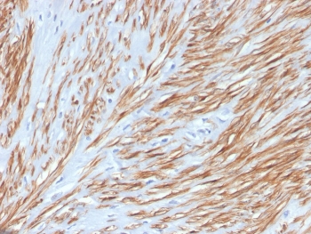CNN1 Antibody Leiomyosarcoma IHC. Immunohistochemistry staining of FFPE human leiomyosarcoma with recombinant CNN1 antibody. HIER: boil tissue sections in pH 9 10mM Tris with 1mM EDTA for 20 min and allow to cool before testing.
