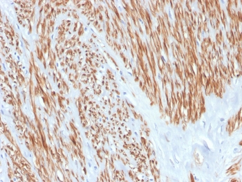 CNN1 Antibody Leiomyosarcoma Immunohistochemistry. IHC analysis of FFPE human leiomyosarcoma with recombinant CNN1 antibody. HIER: boil tissue sections in pH 9 10mM Tris with 1mM EDTA for 20 min and allow to cool before testing.