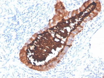 Immunohistochemistry analysis of Recombinant MUC16 Antibody in FFPE human ovarian carcinoma tissue. Strong membranous and apical cytoplasmic HRP-DAB brown staining is observed in malignant epithelial cells, consistent with overexpression of MUC16 / CA125 in ovarian carcinoma, while surrounding stromal cells are largely negative. Clone OCA125/4505R demonstrates clear epithelial surface localization. Heat-induced epitope retrieval was performed in pH 9 Tris-EDTA buffer (10mM Tris, 1mM EDTA) for 20 minutes followed by cooling prior to staining.