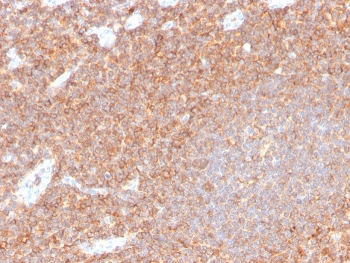 CD44 Antibody Tonsil IHC. Immunohistochemistry analysis of CD44 / CD44 antigen expression in FFPE human tonsil tissue using Cell Surface Receptor Signaling Antibody clone HCAM/4110R. Membranous HRP-DAB brown staining is observed in dense lymphoid cell populations, highlighting cell surface localization consistent with receptor-associated signaling activity. The staining pattern demonstrates widespread distribution across lymphoid regions and supports its use for evaluating membrane-localized receptor expression and cell-environment signaling interactions in tonsil tissue. Heat induced epitope retrieval was performed by boiling tissue sections in pH 9 10mM Tris with 1mM EDTA for 10-20 min followed by cooling at RT for 20 min.