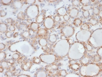 UBR2 Antibody Human Thyroid IHC. Immunohistochemistry analysis of FFPE human thyroid tissue stained with clone PCRP-UBR2-1D12 at 2 ug/ml. Thyroid follicular epithelial cells display cytoplasmic and membranous HRP-DAB brown staining, while surrounding stromal elements show comparatively low background signal. The observed expression pattern is consistent with the involvement of Ubiquitin protein ligase E3 component n-recognin 2 / UBR2 in intracellular protein quality control and ubiquitin-mediated degradation pathways associated with cellular homeostasis. HIER: boil tissue sections in pH 9 10mM Tris with 1mM EDTA for 20 min and allow to cool before testing.