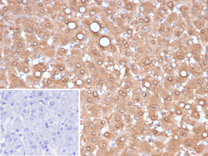 Arginase 1 Antibody ARG1/6790R by IHC in Human Hepatocellular Carcinoma. Immunohistochemistry of FFPE human hepatocellular carcinoma tissue using Arginase 1 Antibody ARG1/6790R, a recombinant rabbit monoclonal antibody. Strong, diffuse brown DAB staining is observed predominantly in the cytoplasm of tumor cells, with occasional nuclear staining and variable cytoplasmic intensity. The staining pattern is consistent with ARG1 expression in hepatocellular carcinoma and its role as a marker of hepatocellular differentiation. Nuclei are counterstained blue with hematoxylin. The lower-left inset shows a secondary-only negative control, with PBS substituted for the primary antibody, demonstrating minimal background staining.