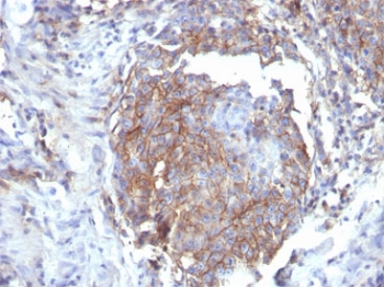 CD44 Antibody Breast Tissue IHC. Immunohistochemistry analysis of CD44 / CD44 antigen expression in FFPE human breast tissue using Epithelial Cell Adhesion Marker Antibody clone rHCAM/6449. Membranous HRP-DAB brown staining is observed in epithelial cell populations, outlining cell borders and highlighting cell surface localization consistent with CD44-mediated adhesion. The staining pattern demonstrates cohesive epithelial organization with defined cellular clusters and supports its use for evaluating cell-cell interaction, membrane integrity, and structural arrangement in breast tissue. Heat induced epitope retrieval was performed by boiling tissue sections in pH 9 10mM Tris with 1mM EDTA for 20 min followed by cooling before testing.