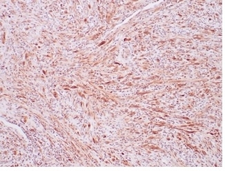 ALK Antibody IMT Spindle Cell IHC. Immunohistochemistry staining of FFPE human inflammatory myofibroblastic tumor tissue using recombinant monoclonal clone ALK1/7008R demonstrates diffuse cytoplasmic HRP-DAB brown staining within spindle-shaped myofibroblastic tumor cells arranged in fascicular stromal patterns. The observed staining profile supports expression of ALK fusion-associated kinase protein in inflammatory myofibroblastic tumor-associated mesenchymal cellular populations. HIER: boil tissue sections in pH 9 10mM Tris with 1mM EDTA for 20 min and allow to cool before testing.