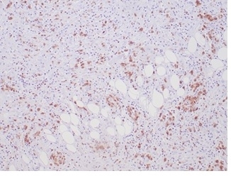 ALK Antibody ALCL Stromal Interface IHC. Immunohistochemistry staining of FFPE human anaplastic large cell lymphoma tissue using recombinant monoclonal clone ALK1/7008R demonstrates scattered cytoplasmic HRP-DAB brown staining in malignant lymphoid cells distributed within fibrotic and adipose-associated stromal compartments. The staining pattern is consistent with ALK fusion protein-associated expression in ALK-positive lymphoma and highlights oncogenic kinase signaling within neoplastic hematolymphoid cellular populations. HIER: boil tissue sections in pH 9 10mM Tris with 1mM EDTA for 20 min and allow to cool before testing.
