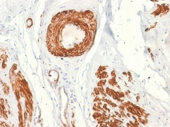Caldesmon Antibody / CALD1 Cellular Mechanical Stress Response Protein Antibody. Immunohistochemistry analysis of Caldesmon (CALD1) in human leiomyosarcoma tissue. FFPE human leiomyosarcoma stained with Caldesmon Antibody, clone rCALD1/820, demonstrates strong HRP-DAB brown cytoplasmic staining in tumor cells with smooth muscle differentiation. The staining highlights densely packed, spindle-shaped tumor cells arranged in intersecting fascicles, consistent with cytoskeletal reinforcement and mechanical stress-adapted structural organization. Prominent staining in vascular smooth muscle structures further supports localization of CALD1 to mechanically resilient contractile cell populations. Heat-induced epitope retrieval was performed using Tris-EDTA buffer at pH 9.