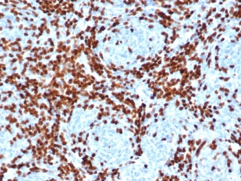 DNA nucleotidylexotransferase Antibody Thymus Immunohistochemistry. IHC staining of FFPE human thymus tissue with DNA nucleotidylexotransferase antibody (clone DNTT/4506R). HIER: boil tissue sections in pH 9 10mM Tris with 1mM EDTA for 20 min and allow to cool before testing.