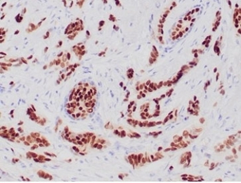 Progesterone Receptor Antibody Recombinant Rabbit MAb PGR/6854R immunohistochemistry analysis of Progesterone receptor / PGR in human breast carcinoma tissue. FFPE human breast carcinoma tissue was stained with Progesterone Receptor Antibody Recombinant Rabbit MAb PGR/6854R following heat induced epitope retrieval by boiling sections in pH 9 10mM Tris with 1mM EDTA for 20 minutes prior to cooling and staining. HRP-DAB brown chromogenic signal reveals nuclear staining in tumor epithelial cells, consistent with the nuclear localization of Progesterone receptor (PGR) in hormone-responsive breast cancer. PR immunohistochemistry staining is widely used in breast cancer diagnostics to evaluate progesterone receptor expression in tumor epithelial cells and to assess hormone receptor status alongside ER and HER2 in breast carcinoma.