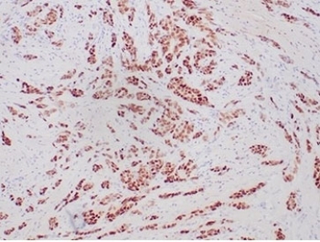Progesterone Receptor Antibody Recombinant Rabbit MAb PGR/6854R immunohistochemistry analysis of Progesterone receptor / PGR in human breast carcinoma. FFPE human breast carcinoma tissue was stained with the recombinant rabbit monoclonal Progesterone Receptor Antibody PGR/6854R following heat induced epitope retrieval by boiling sections in pH 9 10mM Tris with 1mM EDTA for 20 minutes prior to cooling and staining. HRP-DAB brown chromogenic signal demonstrates nuclear staining in malignant epithelial cells within glandular tumor structures, consistent with the nuclear localization of Progesterone receptor (PGR). PR immunohistochemistry staining is widely used in breast cancer diagnostics to evaluate progesterone receptor expression in tumor epithelial cells and determine hormone receptor status alongside ER and HER2.