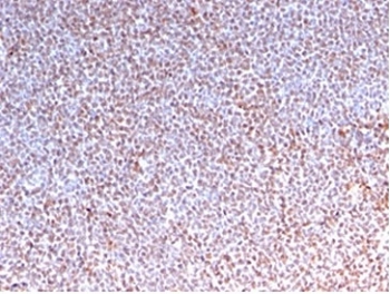 Anaplastic Lymphoma Kinase Antibody ALCL IHC. Immunohistochemistry staining of FFPE human anaplastic large cell lymphoma tissue using recombinant mouse monoclonal clone rALK1/1504 demonstrates extensive nuclear and cytoplasmic HRP-DAB brown staining in malignant lymphoid cells, consistent with expression of oncogenic ALK fusion-associated kinase protein in ALK-positive lymphoma. The diffuse staining pattern supports the established role of Anaplastic Lymphoma Kinase rearrangement-driven signaling in lymphoma pathobiology and precision oncology-associated biomarker analysis. HIER: boil tissue sections in pH 9 10mM Tris with 1mM EDTA for 20 min and allow to cool before testing.