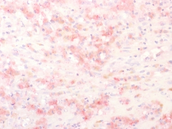 IHC staining of FFPE human melanoma tissue with Tyrosinase-Related Protein-1 antibody using AEC Chromogen (red). HIER: boil tissue sections in pH 9 10mM Tris with 1mM EDTA for 20 min and allow to cool before testing.