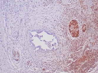 Immunohistochemical staining with recombinant SMAD4 antibody (clone SMAD4/6309R) showing loss of SMAD4 expression in pancreatic ductal adenocarcinoma and positive/retained SMAD4 staining in adjacent benign ductal epithelium and background stroma.