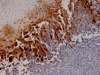 Immunohistochemistry of HSV1 antibody in human esophageal carcinoma tissue. FFPE human esophageal carcinoma sections were subjected to heat-induced epitope retrieval by boiling in pH 9, 10 mM Tris with 1 mM EDTA for 20 minutes followed by cooling prior to staining. The recombinant rabbit monoclonal HSV1 antibody clone HSV1/4055R was used as the detecting antibody. HRP-DAB brown staining is observed predominantly in tumor epithelial cells, with signal localized to the nucleus and cytoplasm of positive cells, while surrounding stromal elements and adjacent non-neoplastic areas show comparatively reduced background staining. The staining pattern is consistent with Herpes simplex virus type 1 antigen expression in carcinoma tissue.