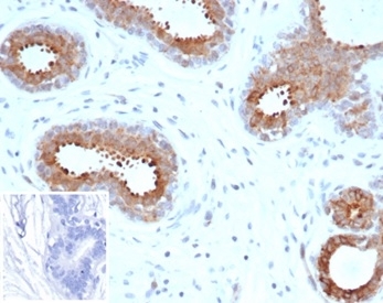 IHC staining of FFPE human breast carcinoma tissue with recombinant BAP1 antibody (clone BAP1/6861R). Negative control inset: PBS instead of primary antibody to control for secondary binding. HIER: boil tissue sections in pH 9 10mM Tris with 1mM EDTA for 20 min and allow to cool before testing.