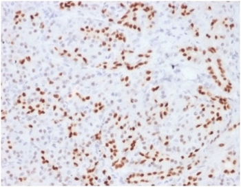 SOX9 Antibody Pancreas Lineage IHC. Immunohistochemistry analysis of FFPE human pancreatic tissue using SOX9 Antibody. Mouse monoclonal antibody clone SOX9/2104 demonstrates strong nuclear HRP-DAB brown staining in pancreatic ductal epithelial cells and scattered lineage-defined epithelial populations, consistent with SOX9âs role as a transcription factor regulating lineage specification. Acinar cells show minimal staining, while stromal components remain largely negative, providing clear contrast of SOX9-positive compartments. The staining pattern highlights epithelial lineage boundaries and progenitor-associated regions within pancreatic tissue. Heat-induced epitope retrieval was performed using pH 9 Tris-EDTA buffer to optimize nuclear antigen detection.