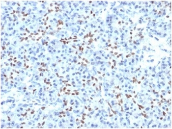 SOX9 Antibody Human Pancreatic Tissue IHC. Immunohistochemistry analysis of SOX9 Antibody / Microarray Specificity Validated Antibody in FFPE human pancreas tissue. The recombinant monoclonal antibody clone PCRP-SOX9-1A2 demonstrates distinct nuclear HRP-DAB brown staining in pancreatic ductal epithelial cells, consistent with the expected nuclear localization of SOX9 as a transcription factor. Acinar cells show minimal to absent staining, while surrounding stromal components remain largely negative, supporting specificity of signal. The clear nuclear staining pattern highlights SOX9 expression in ductal and progenitor-associated epithelial compartments. Microarray-validated specificity supports reliable interpretation of staining in immunohistochemistry and tissue microarray applications. Heat-induced epitope retrieval was performed using 10 mM Tris with 1 mM EDTA, pH 9, by boiling for 20 minutes followed by cooling prior to staining.