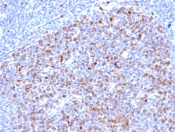Topoisomerase II alpha Antibody / Cell Cycle Regulator Antibody (clone rTOP2A/6629). Immunohistochemistry analysis of FFPE human tonsil tissue shows strong nuclear staining of DNA Topoisomerase II alpha in proliferating lymphoid cells. Nuclear immunoreactivity is most prominent within germinal center lymphocytes, consistent with elevated expression of this cell cycle regulator in actively dividing immune cells. As a Cell Cycle Regulator Antibody, clone rTOP2A/6629 highlights lymphocyte populations undergoing active cell cycle progression where TOP2A activity supports chromosome organization and mitotic preparation. HIER: boil tissue sections in pH 9 Tris-EDTA buffer for 20 min followed by cooling at RT prior to immunohistochemistry staining.