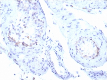 StAR Antibody Recombinant Rabbit MAb STAR/3915R. Immunohistochemistry analysis of Steroidogenic Acute Regulatory Protein (StAR / STARD1) in FFPE human testicular carcinoma tissue using a recombinant rabbit monoclonal antibody. HRP-DAB brown cytoplasmic staining highlights tumor cells with steroidogenic differentiation, consistent with the mitochondrial localization of StAR in steroid hormone-producing cells, while surrounding stromal elements show minimal staining. Heat-induced epitope retrieval was performed by boiling tissue sections in pH 9 Tris-EDTA buffer (10mM Tris with 1mM EDTA) for 20 minutes followed by cooling prior to antibody staining.