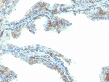 ERG Antibody Prostate Cancer Tissue IHC. Immunohistochemistry of FFPE human prostate carcinoma tissue using ERG antibody highlights strong HRP-DAB brown nuclear staining in tumor epithelial cells, consistent with ERG expression associated with TMPRSS2-ERG fusion-driven prostate cancer, with endothelial cells in surrounding vasculature also showing nuclear positivity; clone ERG/2107 was used for detection. HIER: boil tissue sections in pH 9 10mM Tris with 1mM EDTA for 20 min and allow to cool before testing.