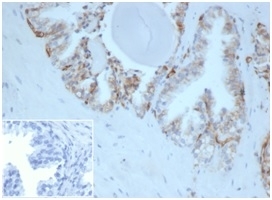 IHC staining of FFPE human prostate tissue with HLA-G antibody (clone HLAG/6686) at 2ug/ml. Negative control inset: PBS instead of primary antibody to control for secondary binding. HIER: boil tissue sections in pH 9 10mM Tris with 1mM EDTA for 20 min and allow to cool before testing.