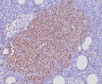 IHC staining of FFPE human mantle cell lymphoma tissue with SOX11 antibody (clone SOX11/7236). HIER: boil tissue sections in pH 9 10mM Tris with 1mM EDTA for 20 min and allow to cool before testing.