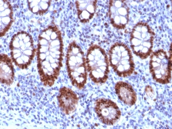 IHC staining of FFPE human colon carcinoma tissue with PU.1 antibody (clone PU1/2118). HIER: boil tissue sections in pH 9 10mM Tris with 1mM EDTA for 20 min and allow to cool before testing.