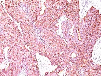 Chromogranin A antibody human small cell lung carcinoma IHC. Immunohistochemistry staining of formalin-fixed, paraffin-embedded human small cell lung carcinoma with Chromogranin A antibody (clone SPM585).