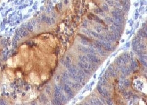 Secretory Component Antibody Immunohistochemistry. IHC: Formalin-fixed, paraffin-embedded human colon carcinoma stained with IgA Secretory Component antibody (SPM217).