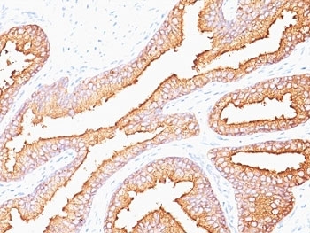 PSA Antibody Mouse Monoclonal for IHC (clone SPM352) immunohistochemistry of human prostate carcinoma. IHC analysis of FFPE human prostate carcinoma tissue using PSA Antibody Mouse Monoclonal for IHC (clone SPM352) shows strong HRP-DAB brown cytoplasmic staining in malignant prostate epithelial cells lining irregular glandular lumina, consistent with Prostate specific antigen (KLK3) expression in prostate-derived tumor epithelium, while surrounding stromal cells remain largely negative. Antigen retrieval was performed by boiling tissue sections in 10 mM Tris with 1 mM EDTA, pH 9 for 10-20 minutes followed by cooling at room temperature for 20 minutes before testing.