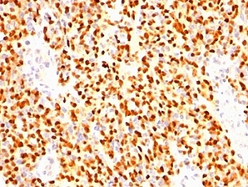 Myogenin Antibody Clone SPM144 immunohistochemistry analysis of Myogenin in human rhabdomyosarcoma. Formalin-fixed paraffin-embedded human rhabdomyosarcoma tissue stained with Myogenin antibody shows strong HRP-DAB brown chromogenic staining localized to the nuclei of tumor cells. The staining highlights numerous malignant cells with distinct nuclear positivity consistent with the role of Myogenin / MYOG as a nuclear transcription factor involved in skeletal muscle differentiation. Surrounding stromal elements show minimal staining, while tumor cell nuclei demonstrate the characteristic nuclear pattern associated with rhabdomyosarcoma.