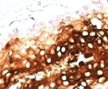 IHC: Formalin-fixed, paraffin-embedded human skin stained with CK17/Cytokeratin 17 antibody clone SPM560.