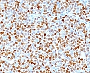 IHC: Formalin-fixed, paraffin-embedded human mantle cell lymphoma stained with CCND1 antibody (clone SPM587).