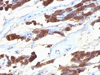 Thyroglobulin Antibody Clone SPM221. Immunohistochemistry analysis of Thyroglobulin using Thyroglobulin Antibody Clone SPM221 in FFPE human thyroid carcinoma tissue section. HRP-DAB brown chromogenic staining highlights cytoplasmic signal in thyroid follicular tumor cells, with staining observed in tumor cell clusters consistent with follicular epithelial differentiation. The staining pattern aligns with the known expression of Thyroglobulin in differentiated thyroid follicular epithelium and thyroid-derived carcinomas.