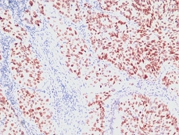 NKX2.1 Antibody / Lung Epithelial Cell Marker Antibody Lung Carcinoma IHC. Immunohistochemistry analysis of human lung carcinoma tissue. FFPE human lung carcinoma sections demonstrate strong HRP-DAB brown nuclear staining in tumor epithelial cells, consistent with expression of the NKX2.1 lung epithelial lineage transcription factor. Positive tumor cell nuclei are distributed throughout the carcinoma cell population, reflecting the role of NKX2.1 as a marker of pulmonary epithelial differentiation and respiratory epithelial lineage identity. Surrounding stromal elements and non-epithelial cells show minimal staining. Nuclear hematoxylin counterstain is visible in blue, highlighting the nuclear localization pattern expected for this lung epithelial transcription factor marker.
