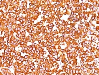 VIM Antibody Clone SPM576 Melanoma IHC. Immunohistochemistry analysis of Vimentin / VIM in human melanoma tissue demonstrating strong cytoplasmic staining in tumor cells, consistent with intermediate filament localization and mesenchymal phenotype. The mouse monoclonal antibody clone SPM576 shows widespread, diffuse cytoplasmic positivity across malignant melanoma cells, with additional staining observed in stromal components. Hematoxylin counterstain (blue) highlights nuclei, and the staining pattern aligns with the known expression of Vimentin in melanoma and other mesenchymal-derived or dedifferentiated tumor cells.