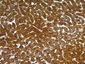 Immunohistochemistry of Hepatocyte antibody in human hepatocellular carcinoma. Formalin-fixed, paraffin-embedded human hepatocellular carcinoma shows strong, diffuse cytoplasmic staining of tumor hepatocytes consistent with hepatocytic differentiation. Clone SPM582 was used for detection.