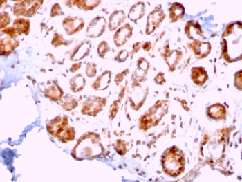 ERCC1 Antibody Breast Carcinoma Tissue IHC. Immunohistochemistry analysis of FFPE human breast carcinoma stained with ERCC1 Antibody (clone ERCC1/2318) demonstrates strong HRP-DAB brown nuclear staining in tumor epithelial cells, consistent with the role of ERCC1 in DNA repair processes, while surrounding stromal cells show lower background; antigen retrieval was performed using Tris-EDTA buffer (pH 9) followed by HRP-polymer detection and DAB development.