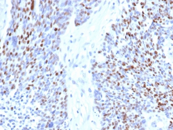 Cyclin E1 Antibody Ovarian Carcinoma IHC. Immunohistochemistry staining of FFPE human ovarian carcinoma tissue with Cyclin E antibody (clone rCCNE1/4936). HIER: boil tissue sections in pH 9 10mM Tris with 1mM EDTA for 20 min and allow to cool before testing.