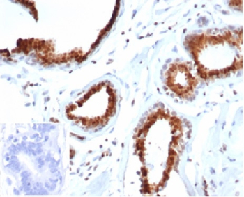 IHC staining of FFPE human breast carcinoma tissue with p27Kip1 antibody (clone rKIP1/1356). Negative control inset: PBS used instead of primary antibody to control for secondary Ab binding. HIER: boil tissue sections in pH 9 10mM Tris with 1mM EDTA for 20 min and allow to cool before testing.