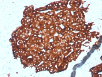 Synaptophysin Antibody Microarray Specificity Validated Clone SYP/4389R. Immunohistochemistry analysis of FFPE human pancreatic tissue using Synaptophysin Antibody Microarray Specificity Validated Clone SYP/4389R. The monoclonal antibody clone SYP/4389R produces strong cytoplasmic staining in pancreatic islet cells consistent with Synaptophysin / SYP expression in neuroendocrine cells. Synaptophysin is a synaptic vesicle membrane glycoprotein widely used as a marker of neuroendocrine differentiation, and the observed granular cytoplasmic staining pattern aligns with the known localization of SYP within synaptic vesicles. Microarray specificity validation of clone SYP/4389R supports selective target recognition, helping confirm specific detection of Synaptophysin protein in immunohistochemistry analysis of formalin-fixed paraffin-embedded pancreatic tissue.