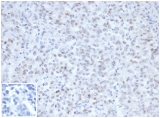 IHC staining of FFPE Lynch Syndrome / Hereditary Non-Polyposis Colorectal Cancer (HNPCC) with MLH1 antibody (clone MLH1/6467) at 2ug/ml in PBS, 30 min RT. Negative control inset: PBS instead of primary antibody to control for secondary binding. HIER: boil tissue sections in pH 9 10mM Tris with 1mM EDTA for 20 min and allow to cool before testing.