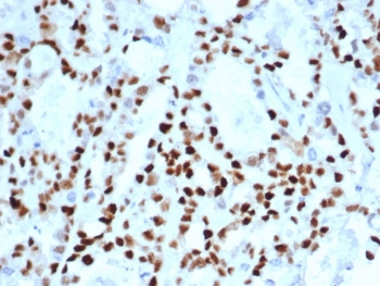 IHC staining of FFPE human ovarian carcinoma tissue with CCNE1 antibody (clone CCNE1/4935R). HIER: boil tissue sections in pH 9 10mM Tris with 1mM EDTA for 20 min and allow to cool before testing.