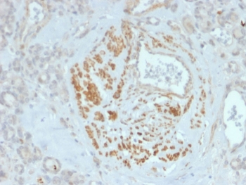 IHC staining of FFPE human breast tissue with HOMEZ antibody (clone PCRP-HOMEZ-1B5). HIER: boil tissue sections in pH 9 10mM Tris with 1mM EDTA for 20 min and allow to cool before testing.